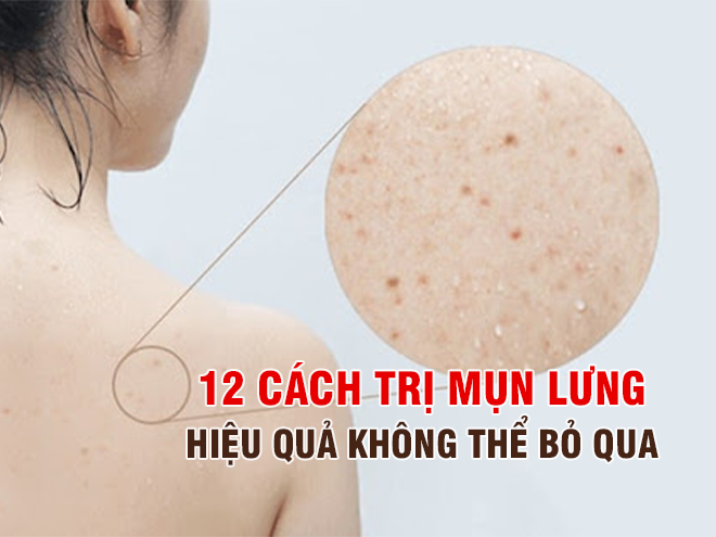  Mách bạn 12 cách trị mụn lưng hiệu quả không thể bỏ qua